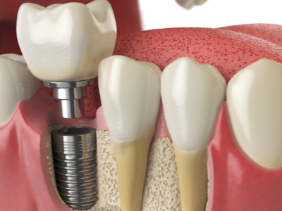 選擇種植牙后要做哪些日常維護(hù)？