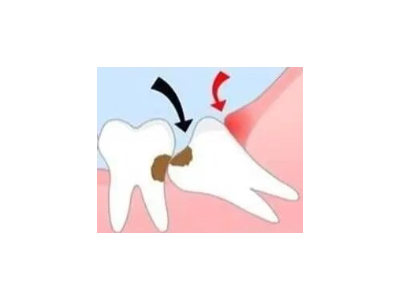 吃完飯后老塞牙？別大意！這可能是你的牙齒在報(bào)警