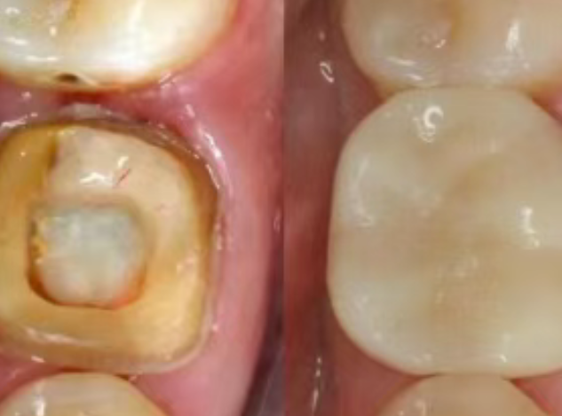 根管治療（抽神經(jīng)）后，為什么一定要做牙冠？