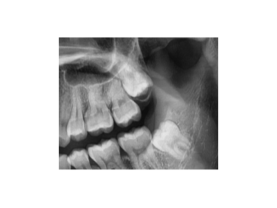 既然「智齒」不宜久留，為什么不能一次性拔掉？