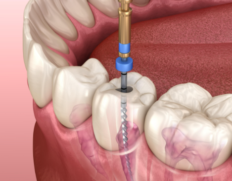 根管治療后的注意事項有哪些？